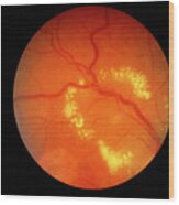 Fundus Camera Image Of A Diabetic Retina Wood Print