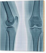 Healthy Knee, X-ray Wood Print