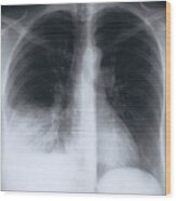 X-ray Image Of Chest Wood Print