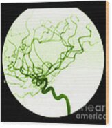 Internal Carotid Cerebral Angiogram #1 Wood Print