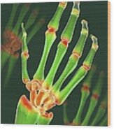 Arthritic Hand, X-ray Artwork Wood Print