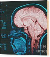 Cerebral Angiography Wood Print