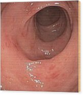 Inflamed Colon From Viral Gastroenteritis Wood Print