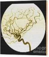 Internal Carotid Cerebral Angiogram Wood Print