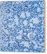 Neuroblastoma Wood Print Neuroblastoma Wood Print