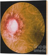 Retina Infected By Syphilis Wood Print
