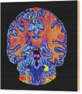 Coronal View Mri Of Normal Brain Wood Print