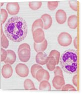 Neutrophils In Peripheral Blood Smear Wood Print