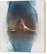 Osteoarthritis Of The Knee Joint #1 Wood Print