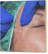 Mesotherapy Thread Face Lift Procedure #13 Wood Print