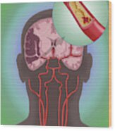 Ischemic Stroke, Illustration #5 Wood Print