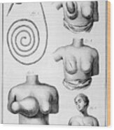 Breast Surgery, 1751-1777 Wood Print