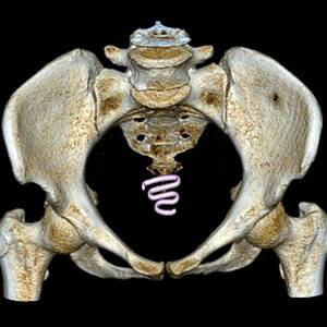 Intrauterine Device In Position #1 by Science Photo Library