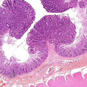 Large Bowel Polyps Photograph by Microscape - Fine Art America