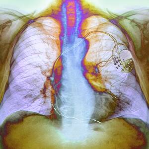 Heart Pacemaker #4 by Science Photo Library