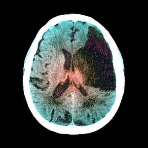 Brain In Stroke by Science Photo Library
