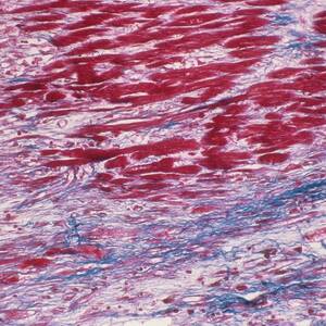 Cardiomyopathy by Science Photo Library