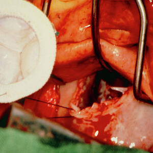 Open Heart Surgery To Implant Artificial Valve by Science Photo Library