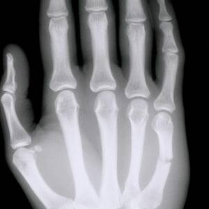 X-ray Of Broken Bone In Right Hand by Science Photo Library