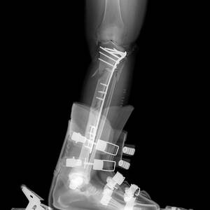 X-ray Of Broken Bones In Ski Boot #2 by Ted Kinsman