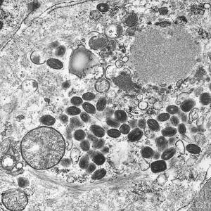 Smallpox Virus, Tem #3 by Science Source
