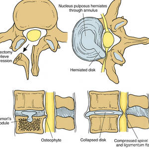 Illustration Of Spinal Disk Pathologies #9 by Science Source