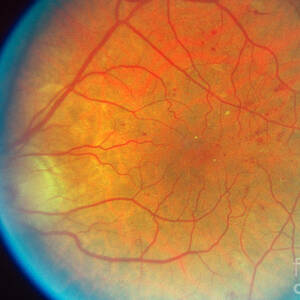 Diabetes And Cataracts by Science Source