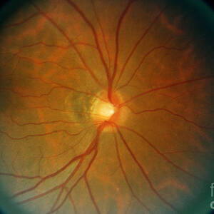 Retina, Lupus Patient by Science Source