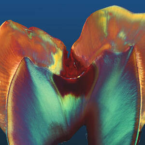Polarised Lm Of A Molar Tooth Showing Decay by Science Photo Library
