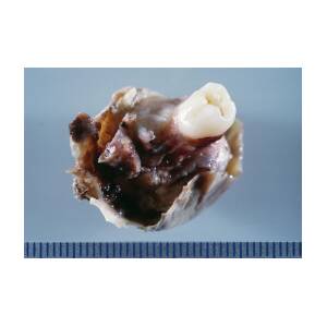 Ovarian teratoma with teeth discovered in remains of 15th century woman