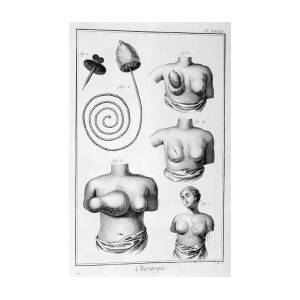 Breast Surgery, 1751-1777 by Print Collector