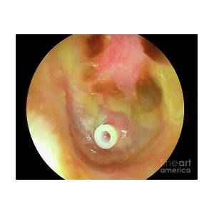 Grommet in the eardrum, otoscope view - Stock Image - C038/5777