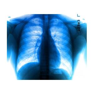 Chest X-ray - Copd And Scoliosis Throw Pillow by Medical Body Scans - Fine  Art America