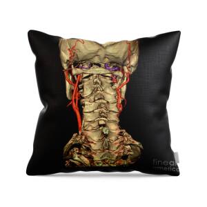 Hip Replacement #3 Throw Pillow by Medical Body Scans - Fine Art America