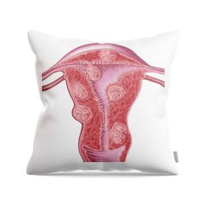 Medical illustration of a pilonidal cyst near the natal cleft of the  buttocks. Throw Pillow for Sale by StocktrekImages